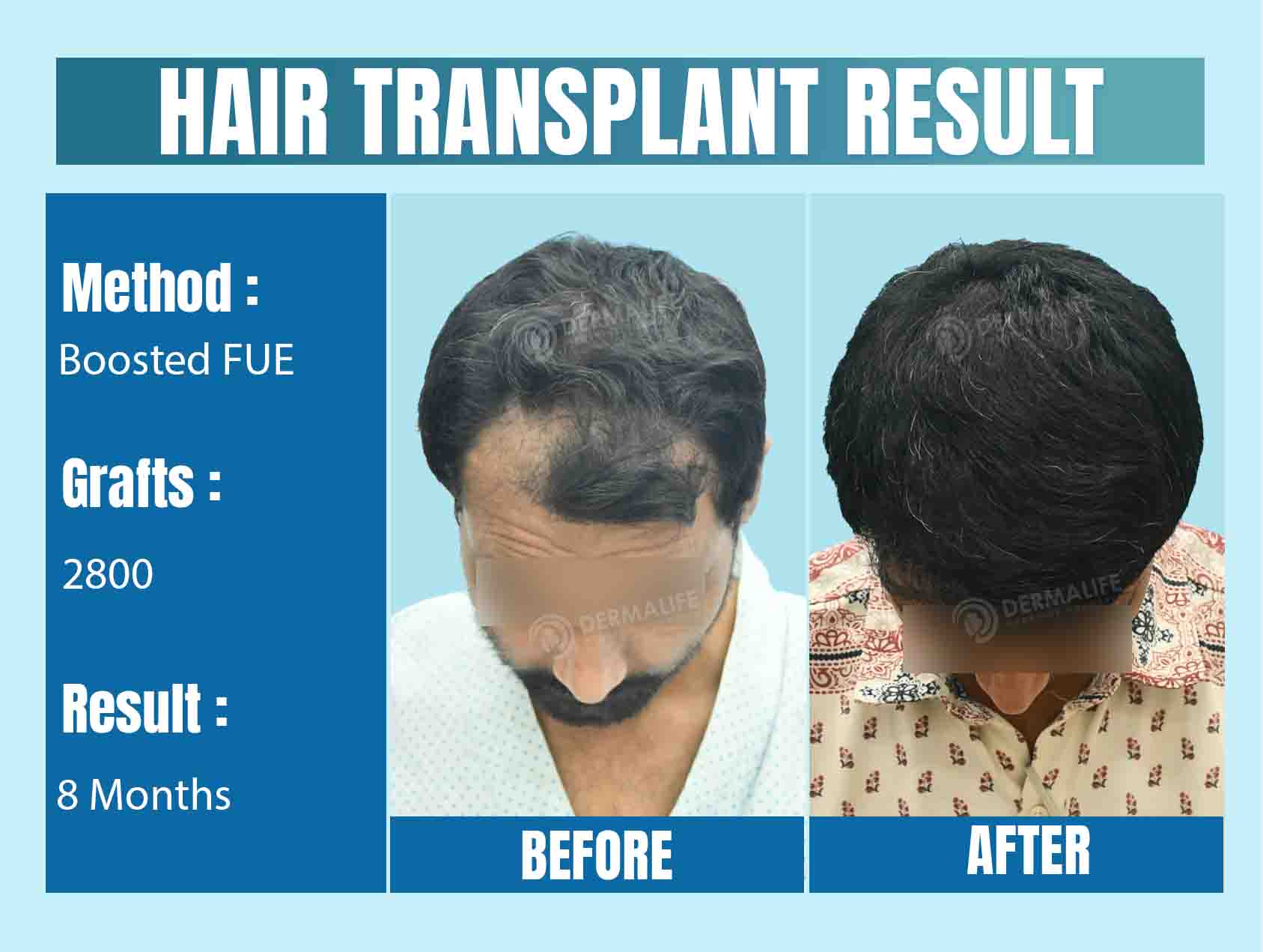World's Best Hair Transplant Surgeon Result