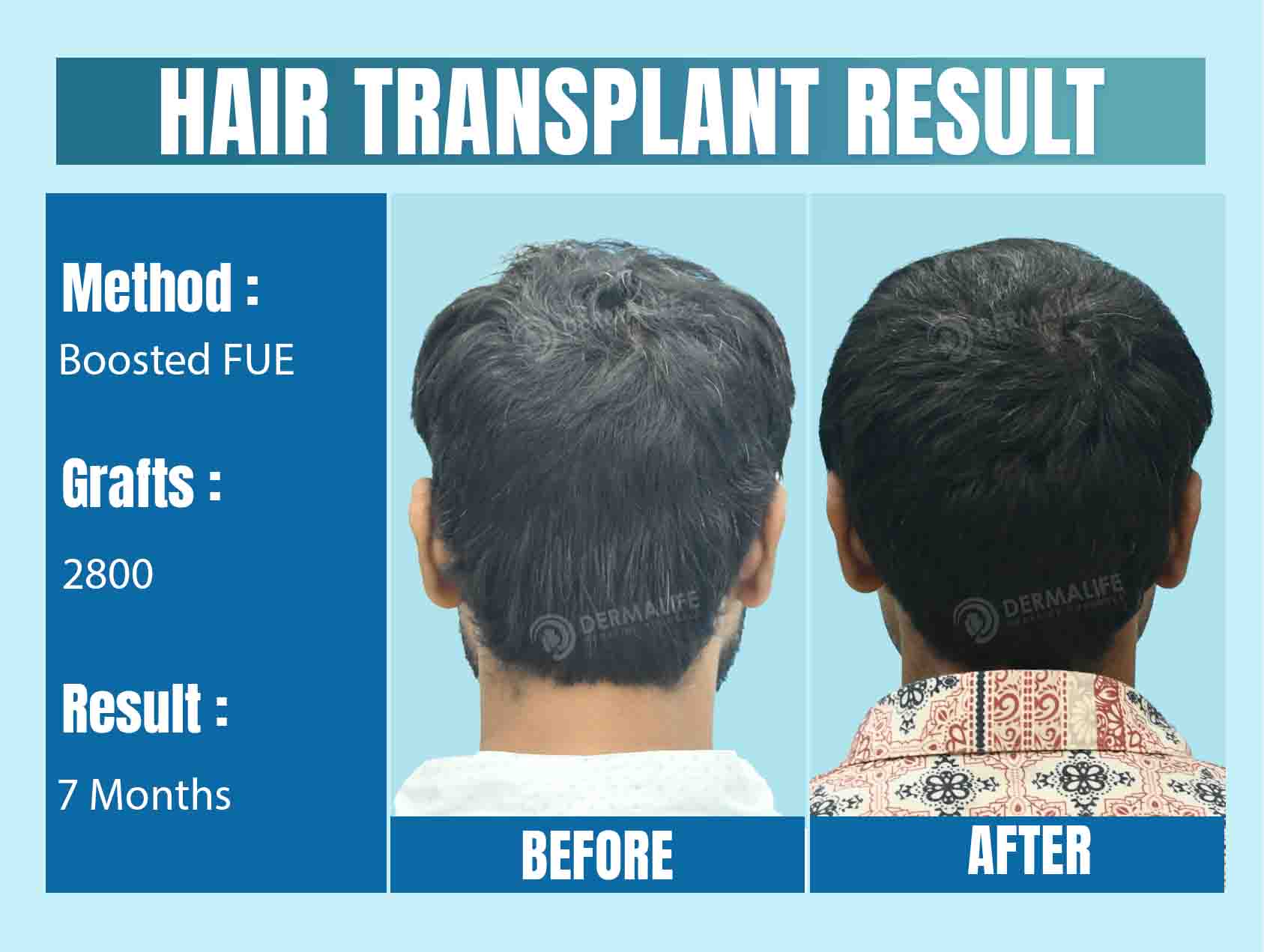 World's Best Hair Transplant Surgeon Result