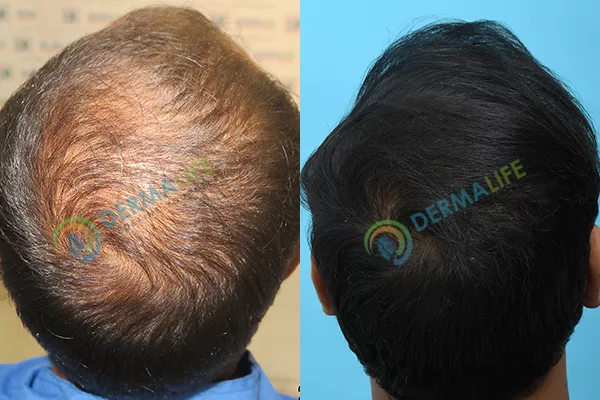 Before and After Results of Hair Transplant for Crown