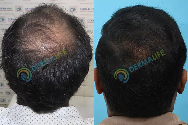 Before and After Results of Hair Transplant for Crown