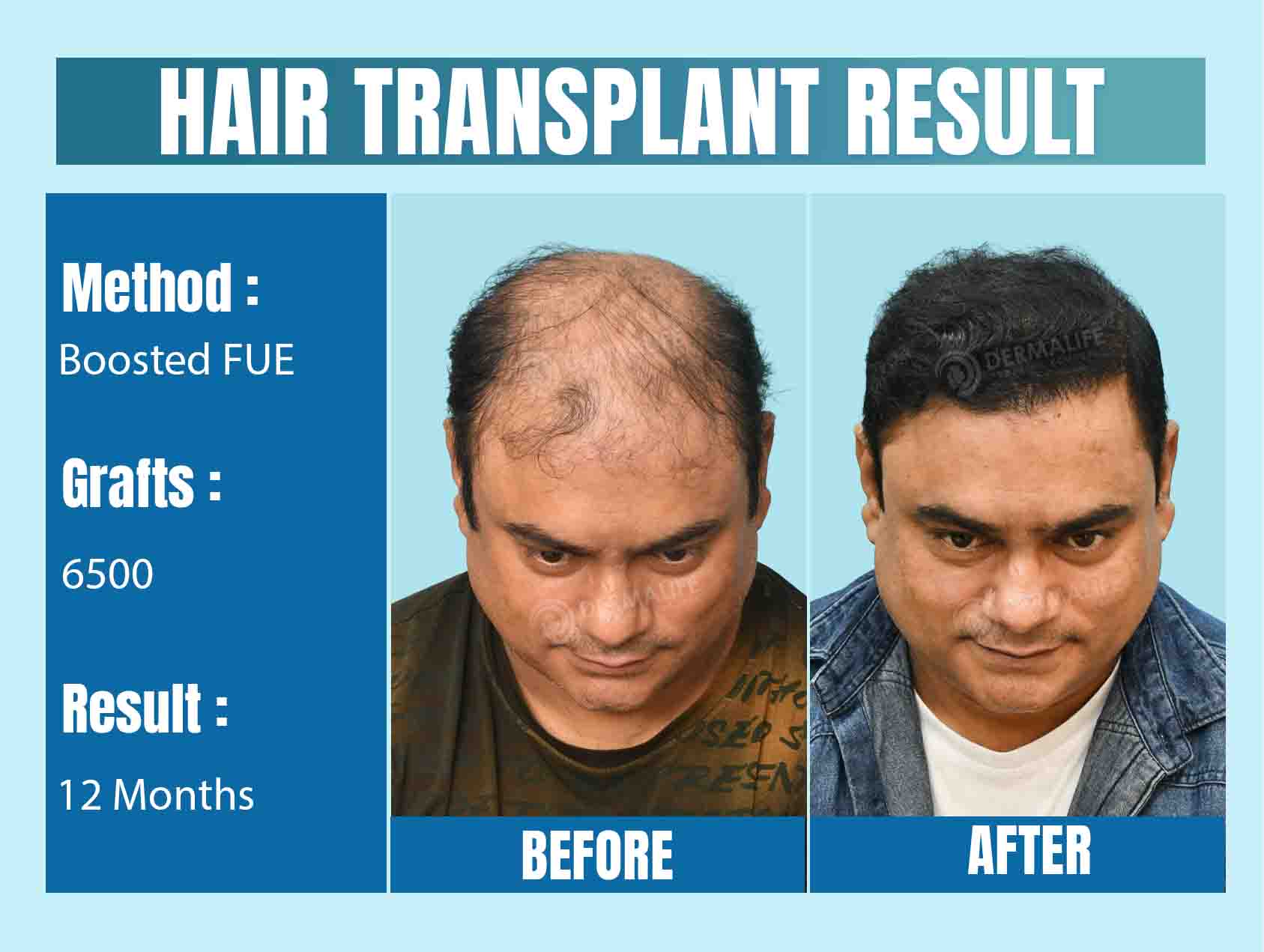 Top celebrity hair transplant doctors in India