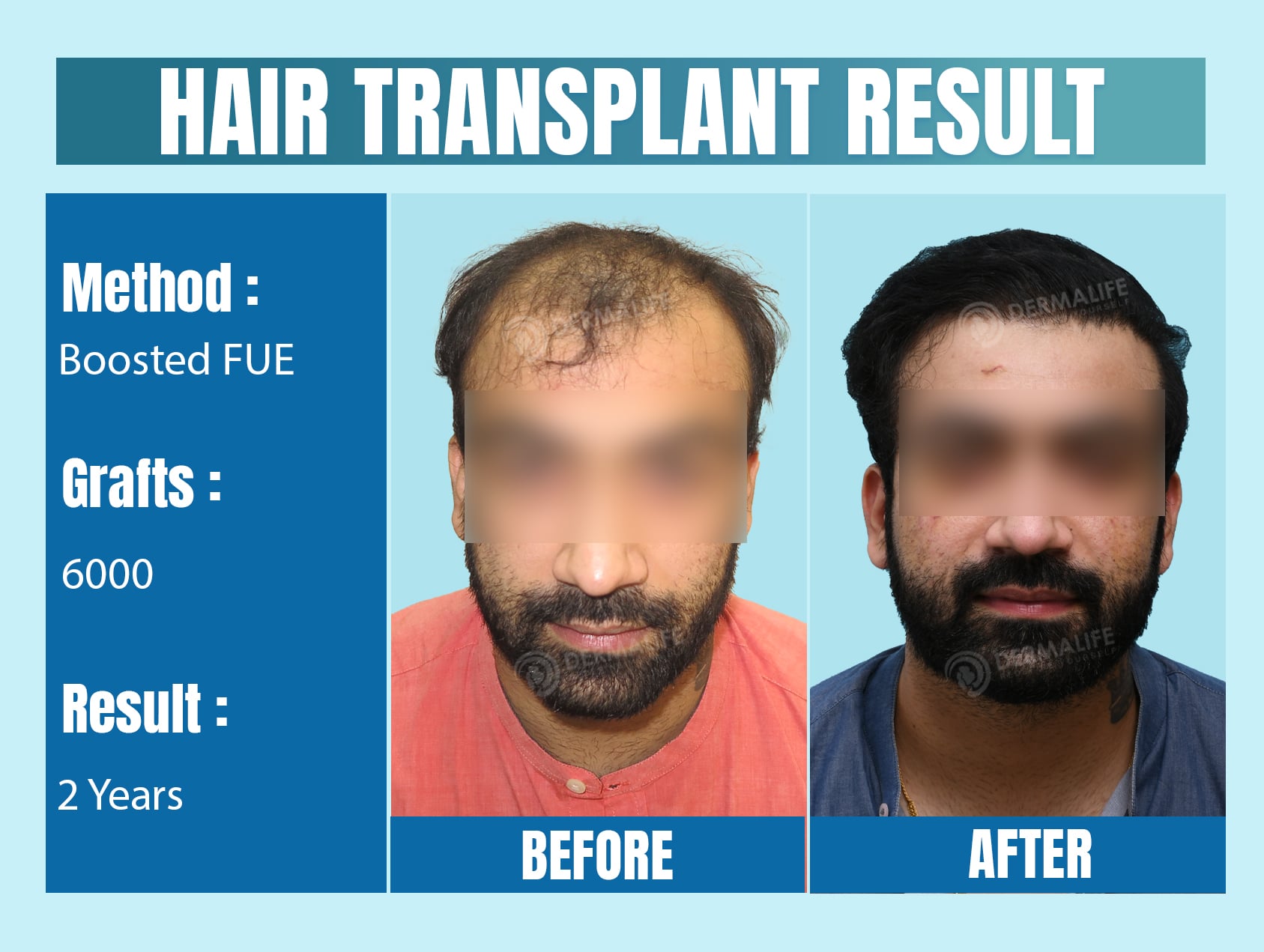 best clinics for hair transplant in Delhi