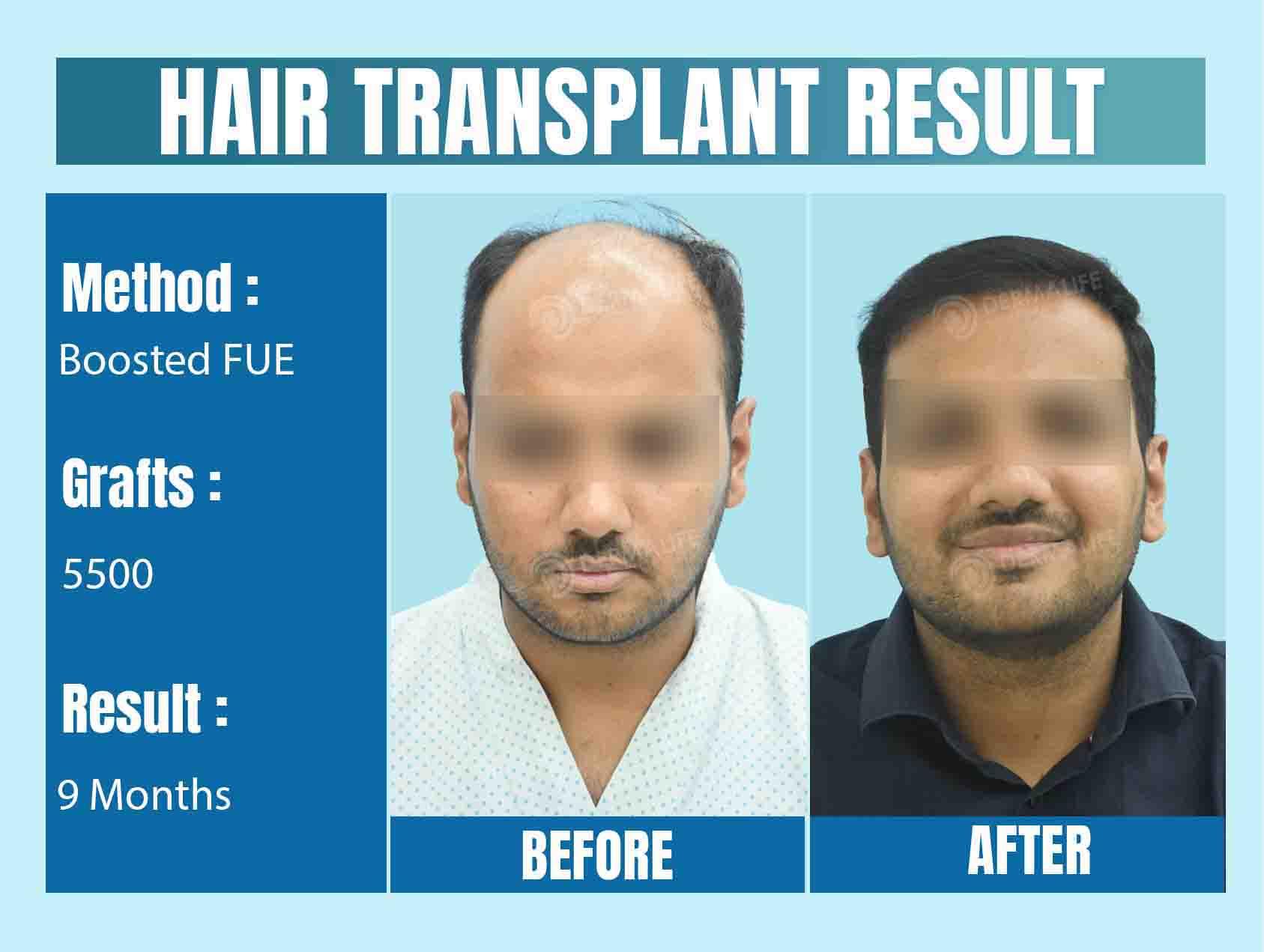 best hair transplant clinic in Delhi-NCR