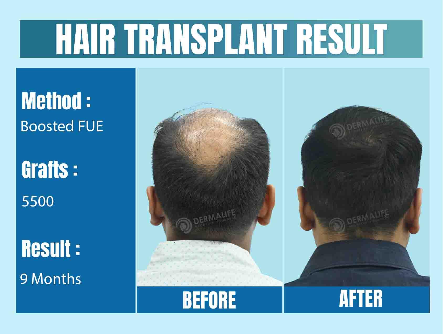 best hair transplant clinic in Delhi-NCR