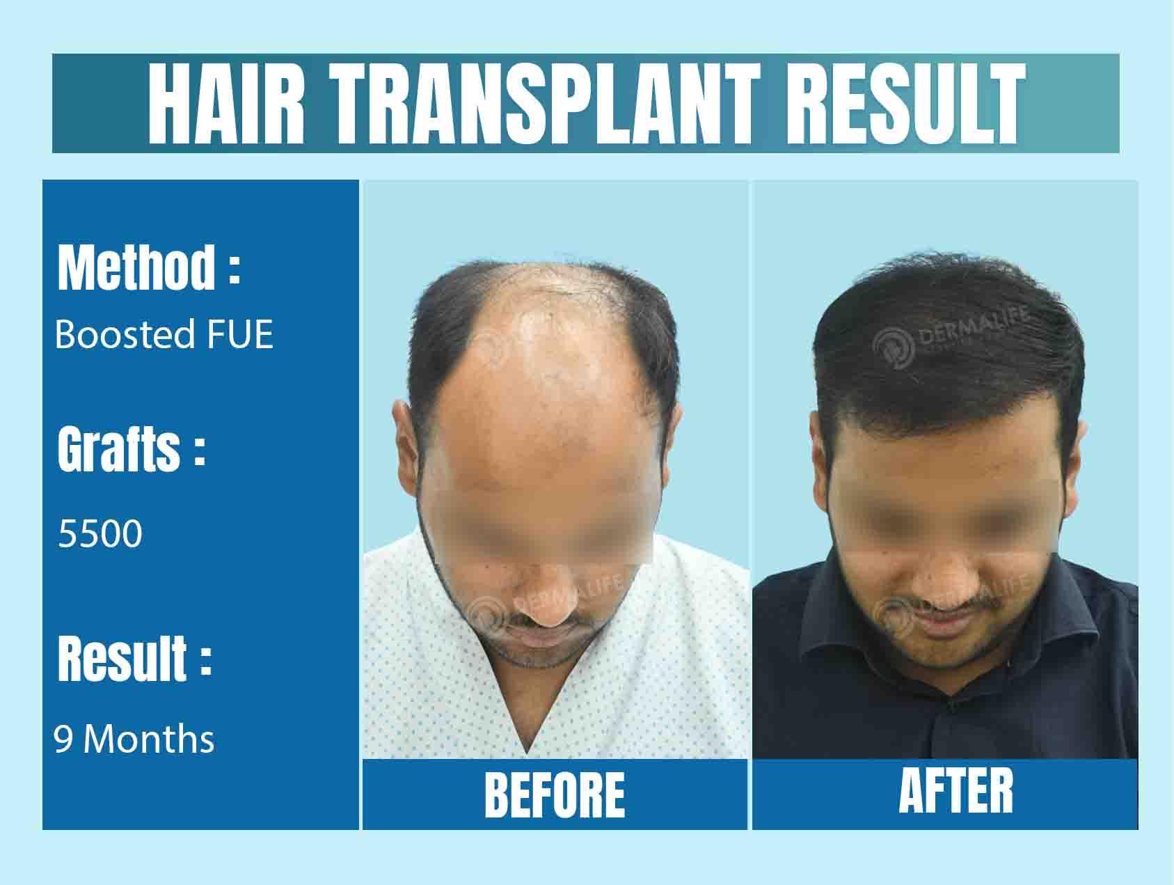 best hair transplant clinic in Delhi-NCR