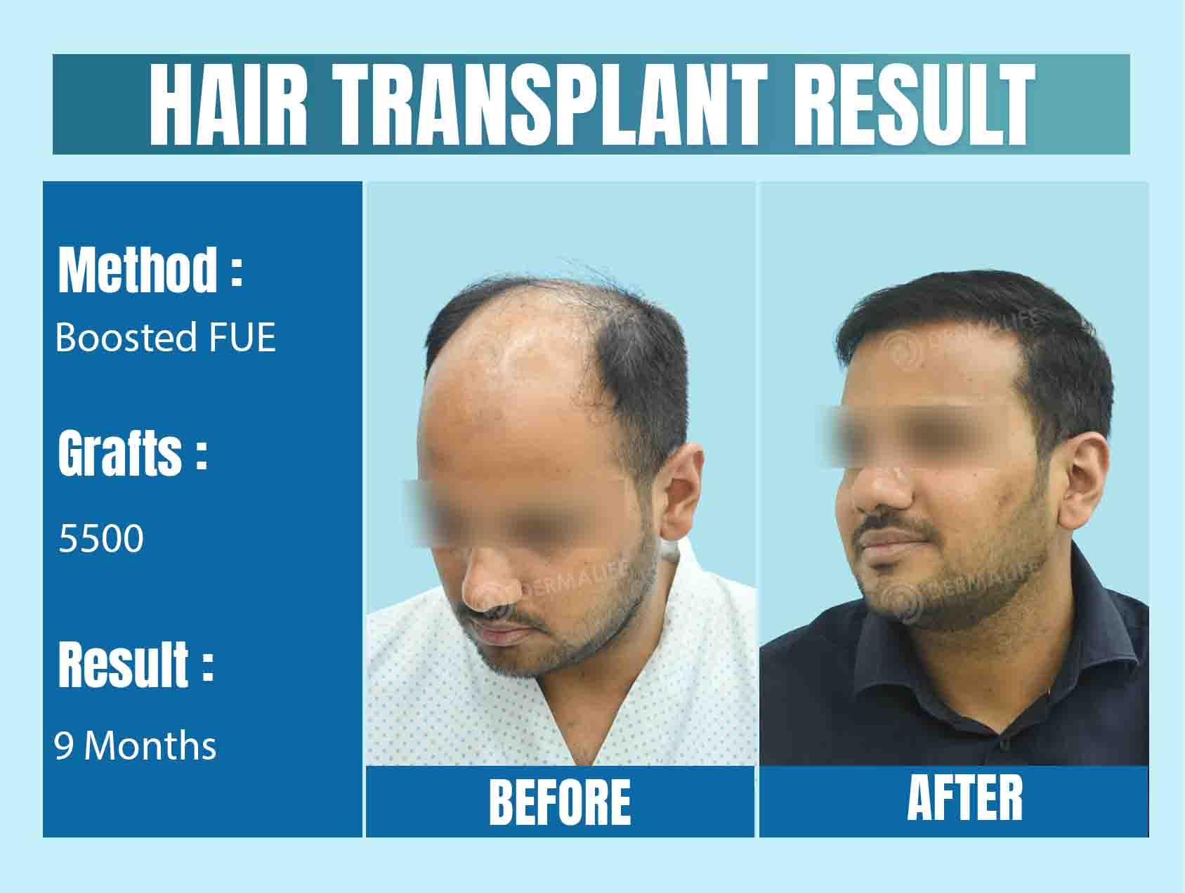 best hair transplant clinic in Delhi-NCR
