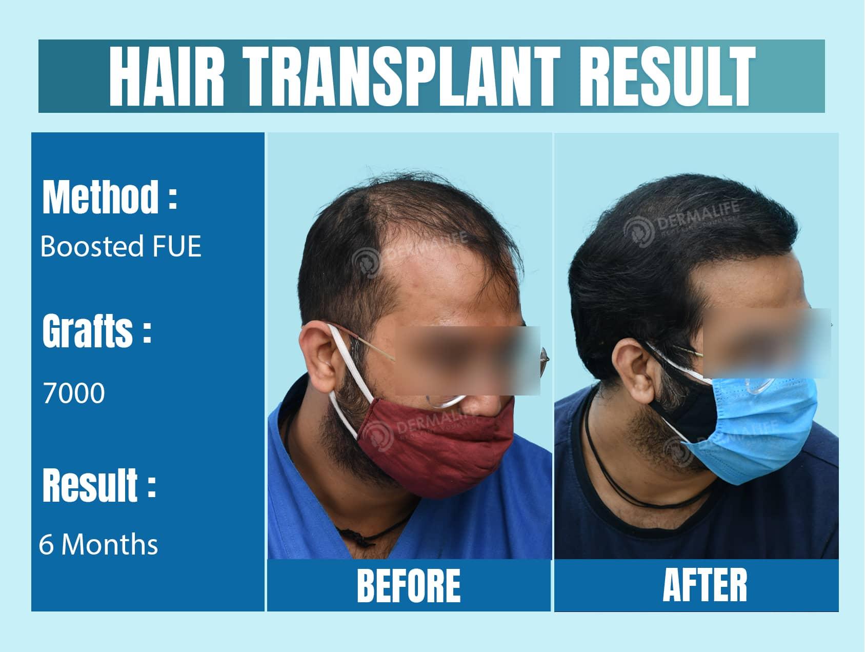 Best hair transplant clinic in delhi