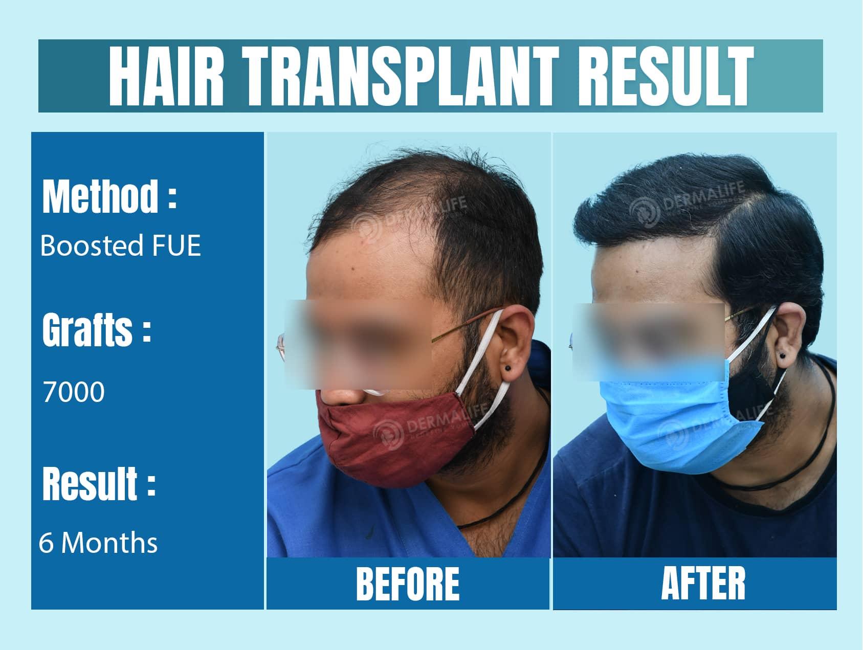 Best hair transplant clinic in delhi