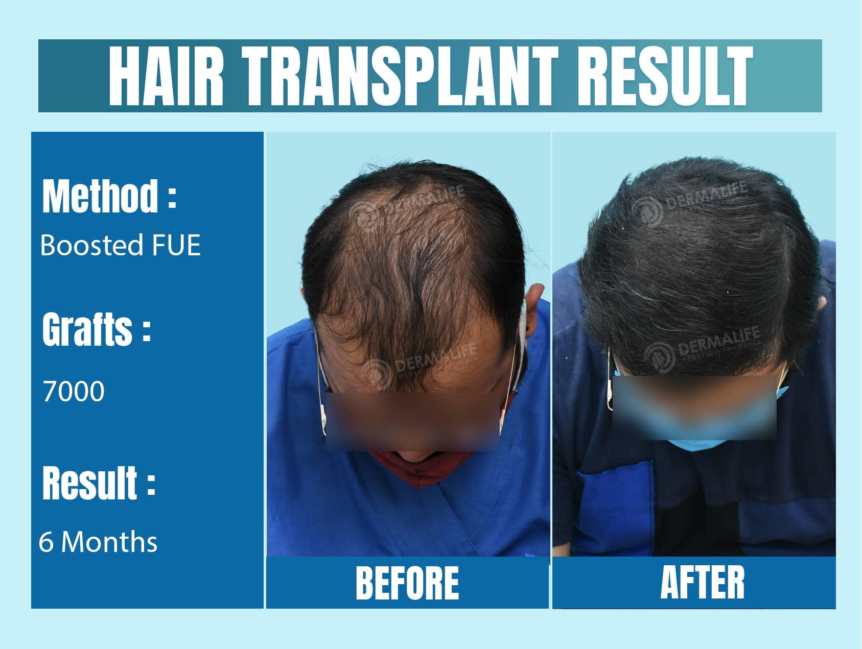 Best hair transplant clinic in delhi