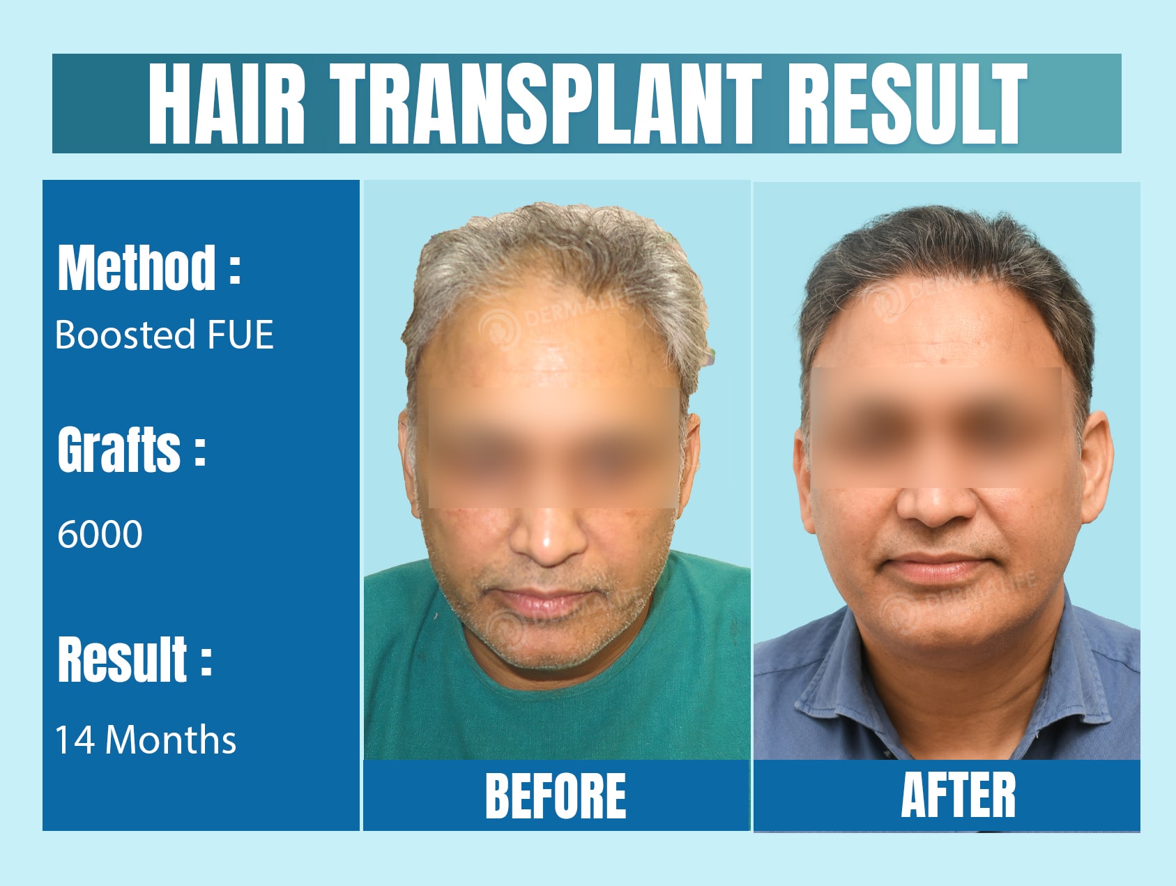 best hair transplant clinic in new delhi