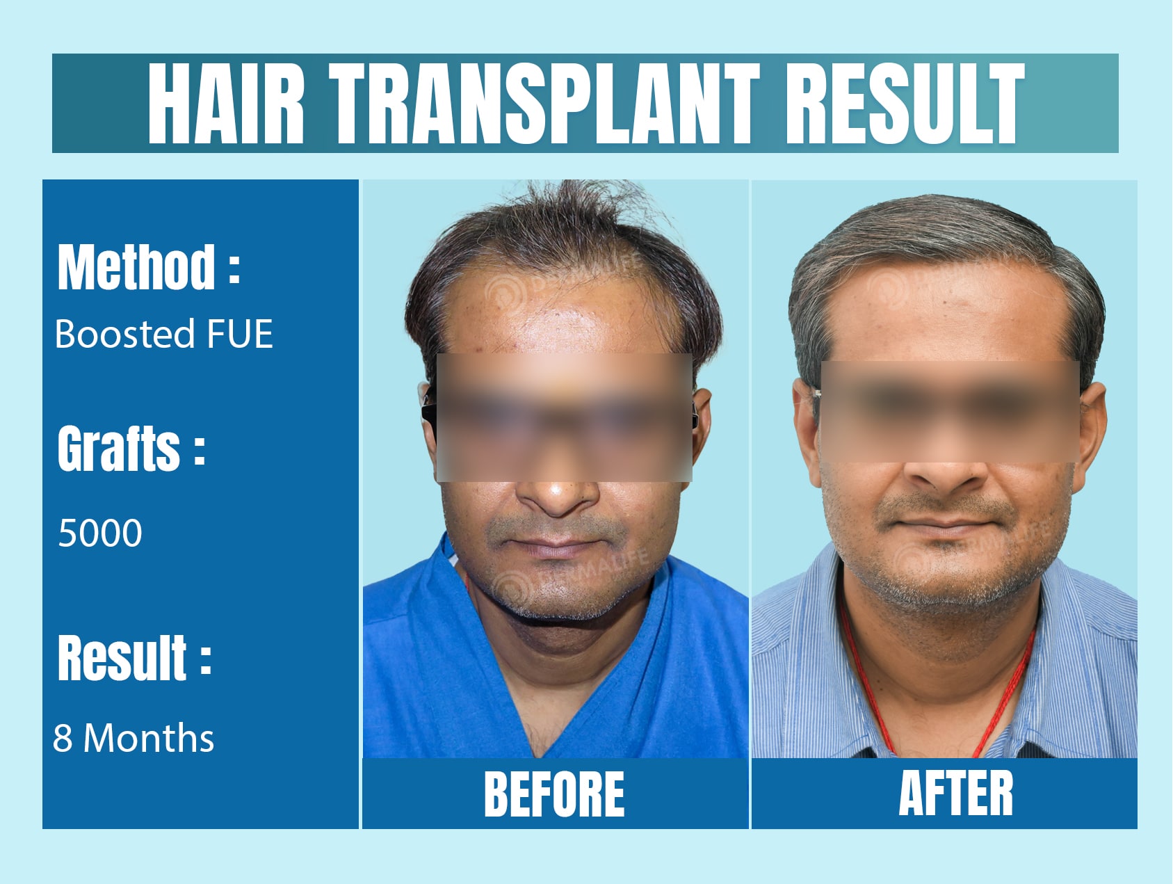 best hair transplant clinic new delhi