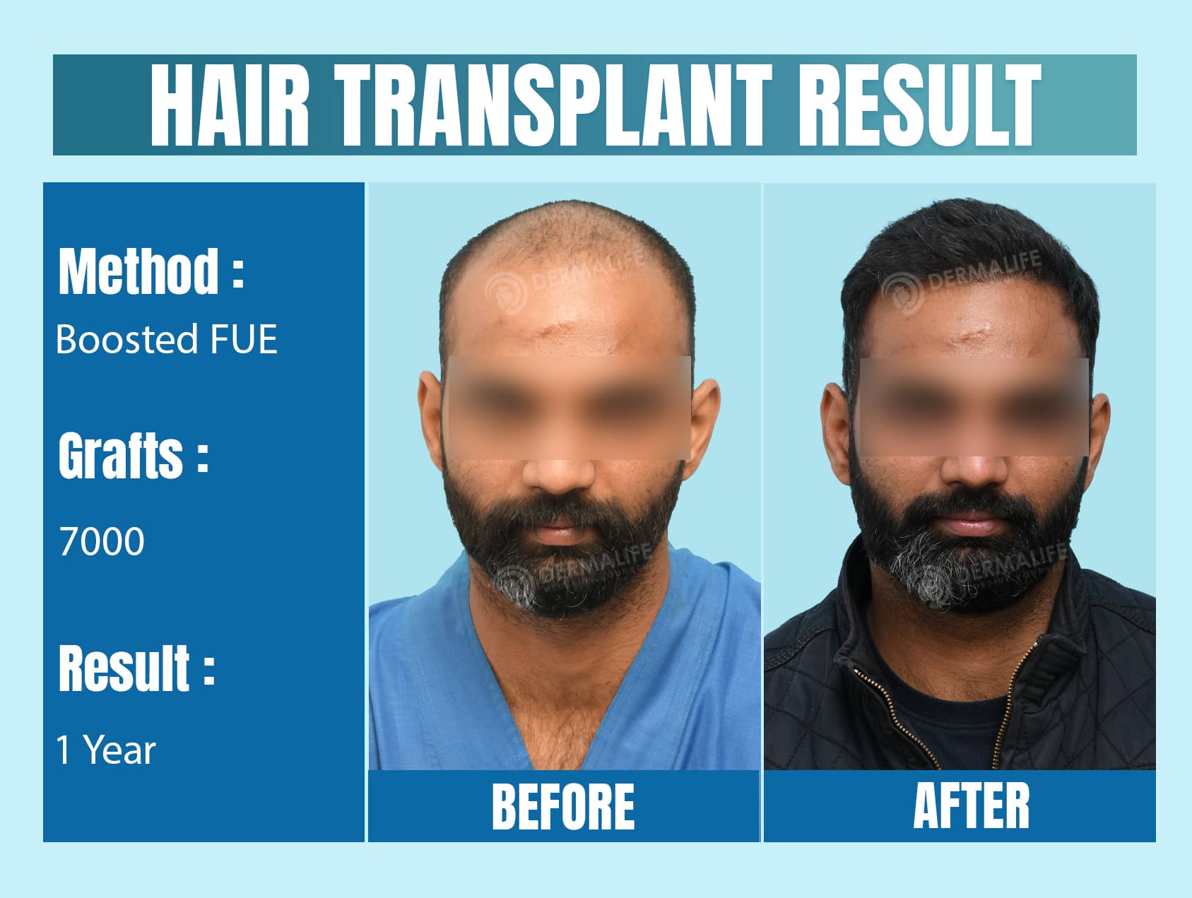 best hair transplants in Delhi