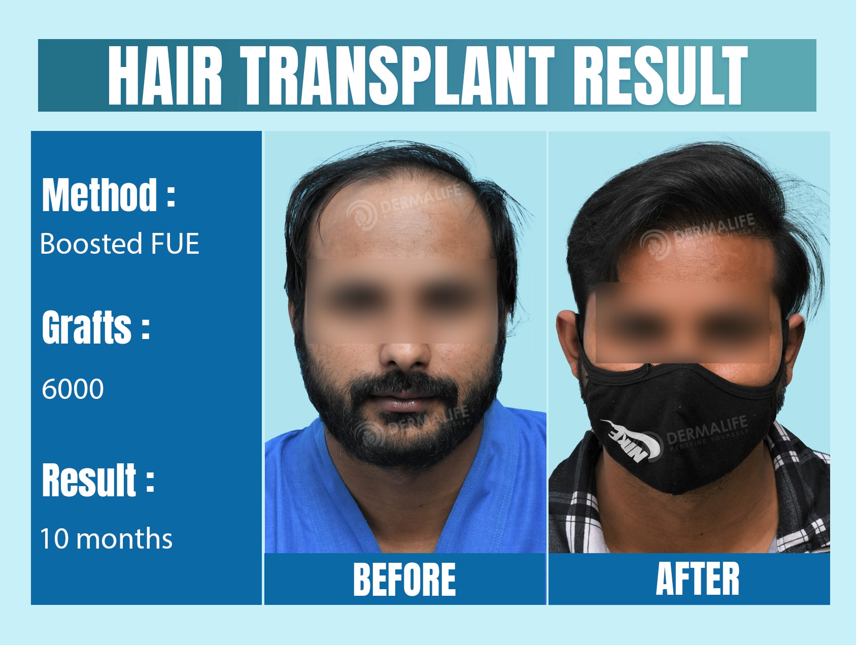 best hair transplant in new delhi