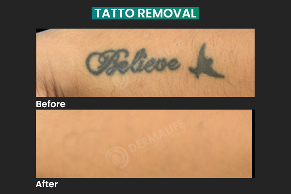 best tattoo removal clinic in delhi NCR