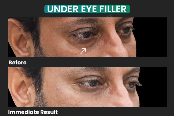 Under eye filler in delhi