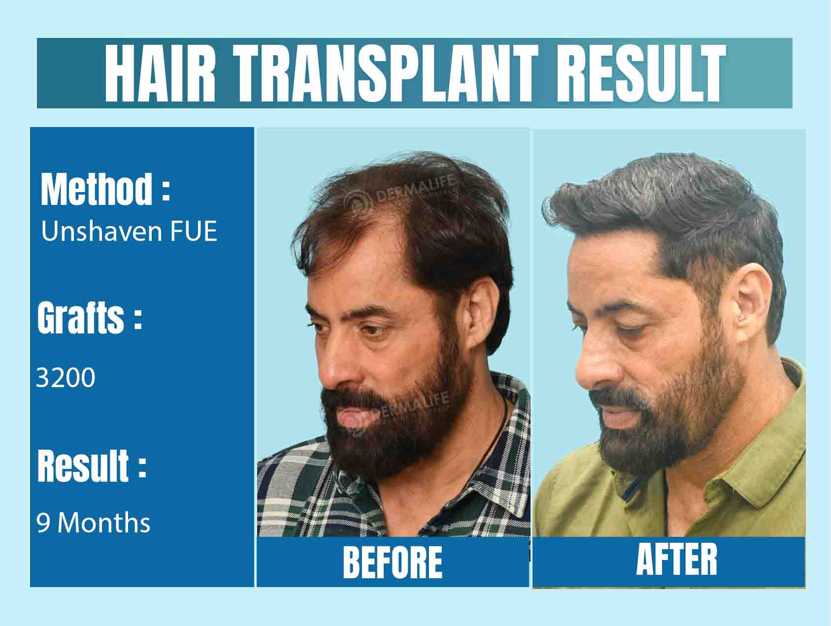 Unshaven FUE hair transplant in India