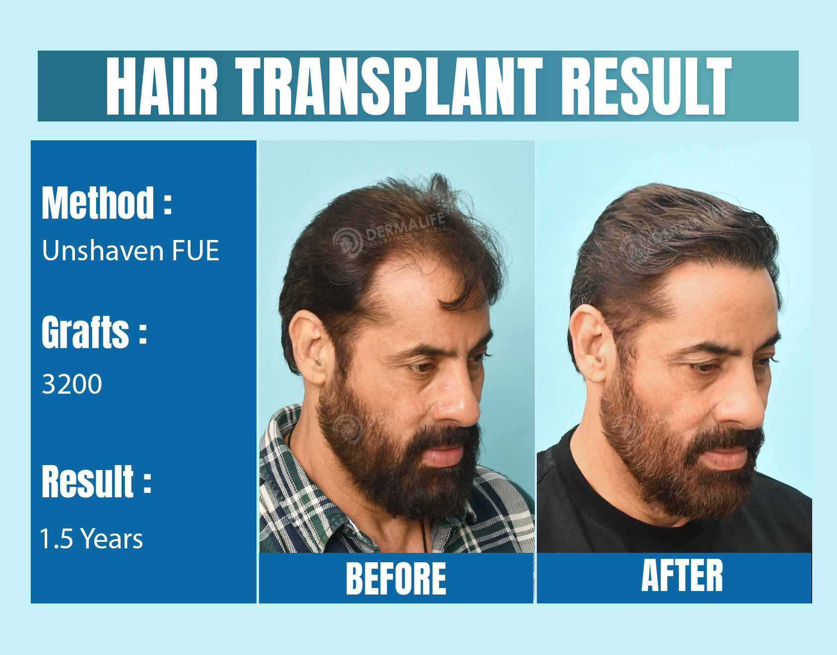 Unshaven FUE hair transplant cost in India