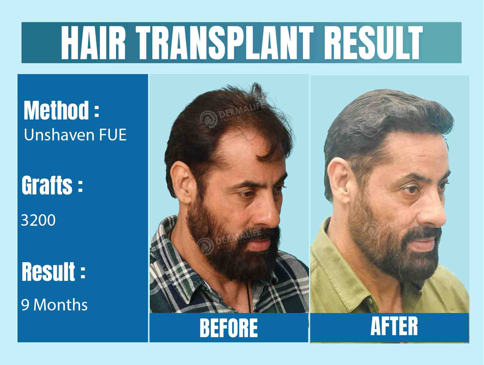Best Unshaven FUE hair transplant in India