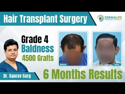 Dermalife hair transplant testimonials
