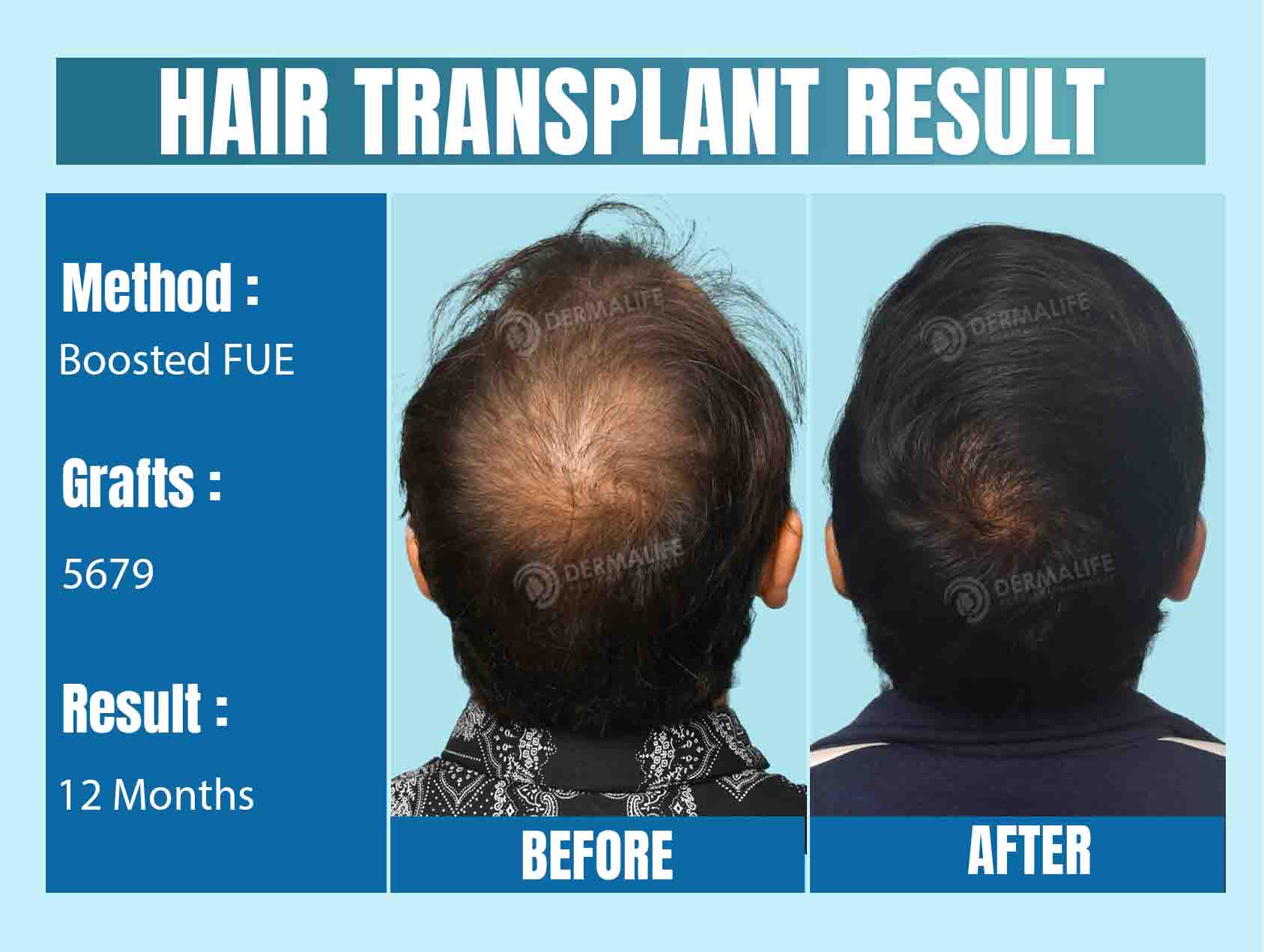 hair Transplant Before & After