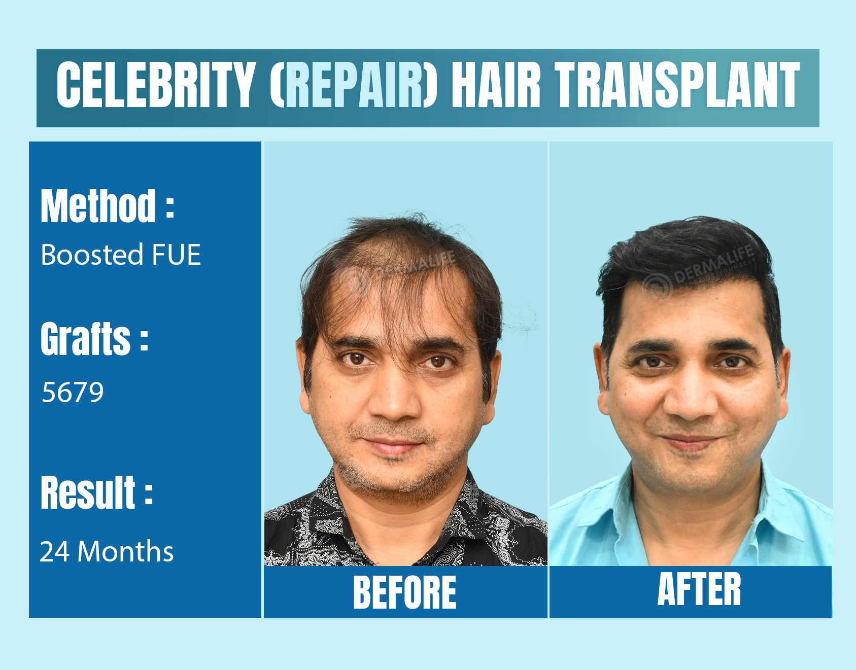 celebrity hair transplant cost in India