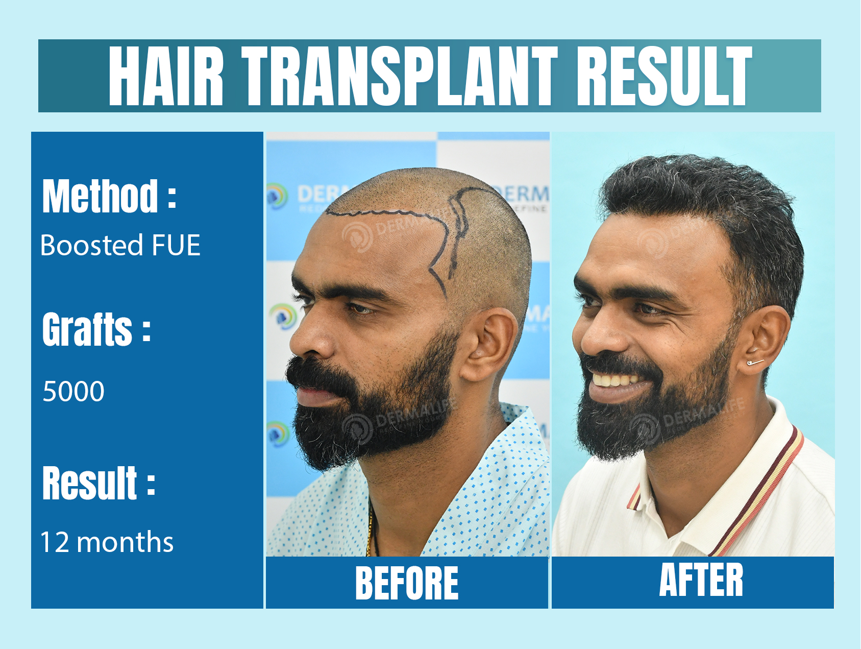 celebrity hair transplant doctors in india