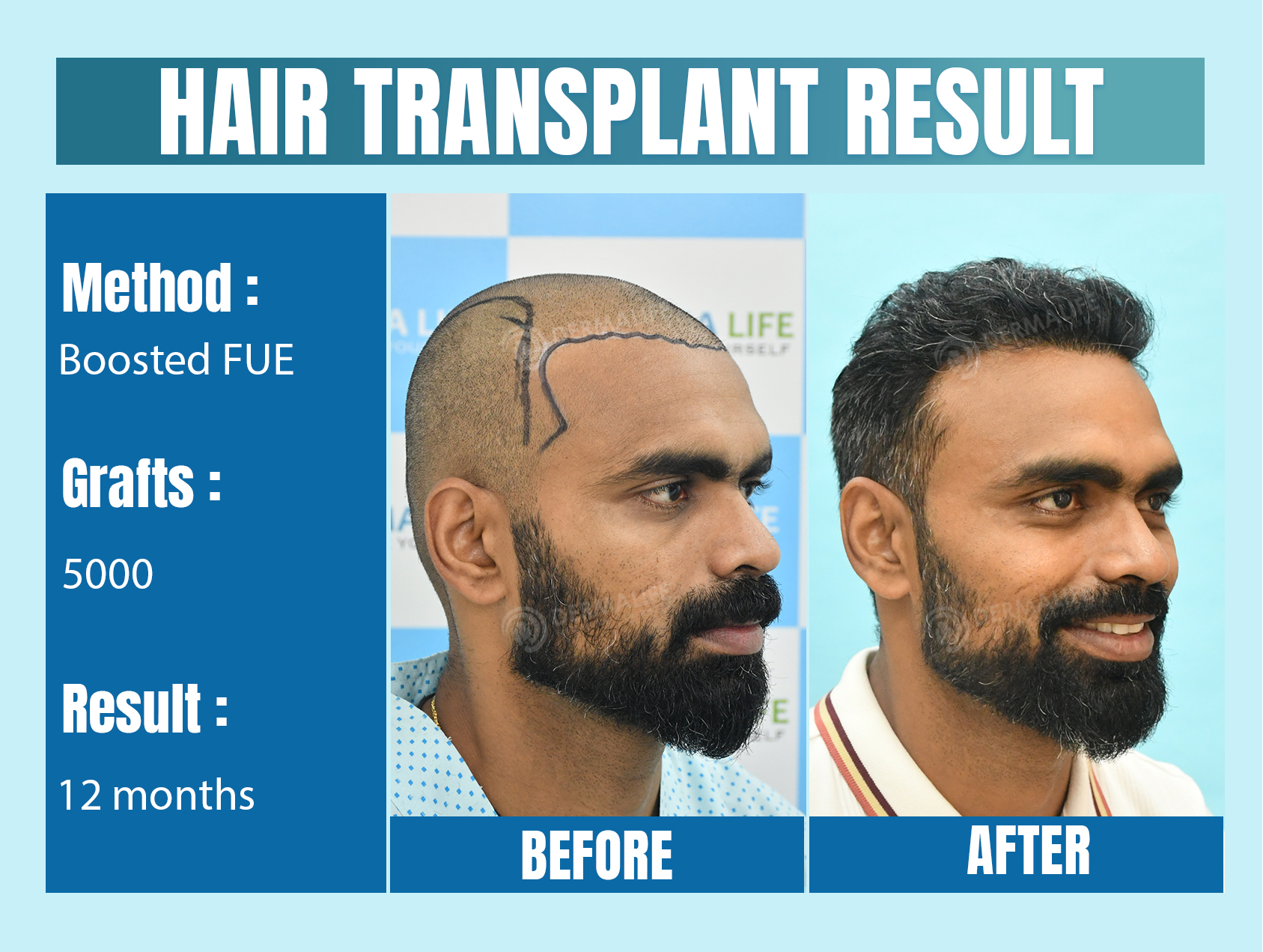 celebrity hair transplant doctors in india