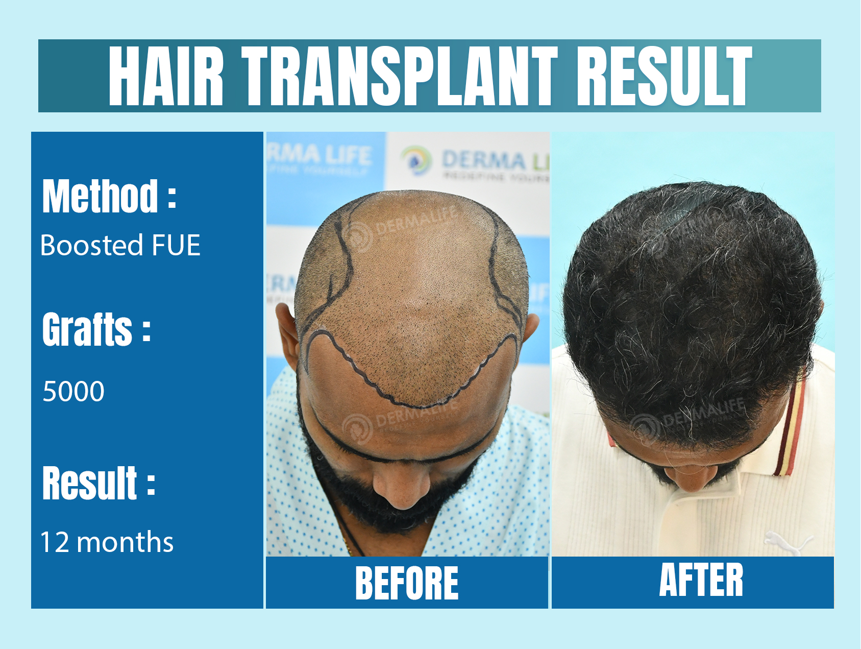 celebrity hair transplant doctors in india