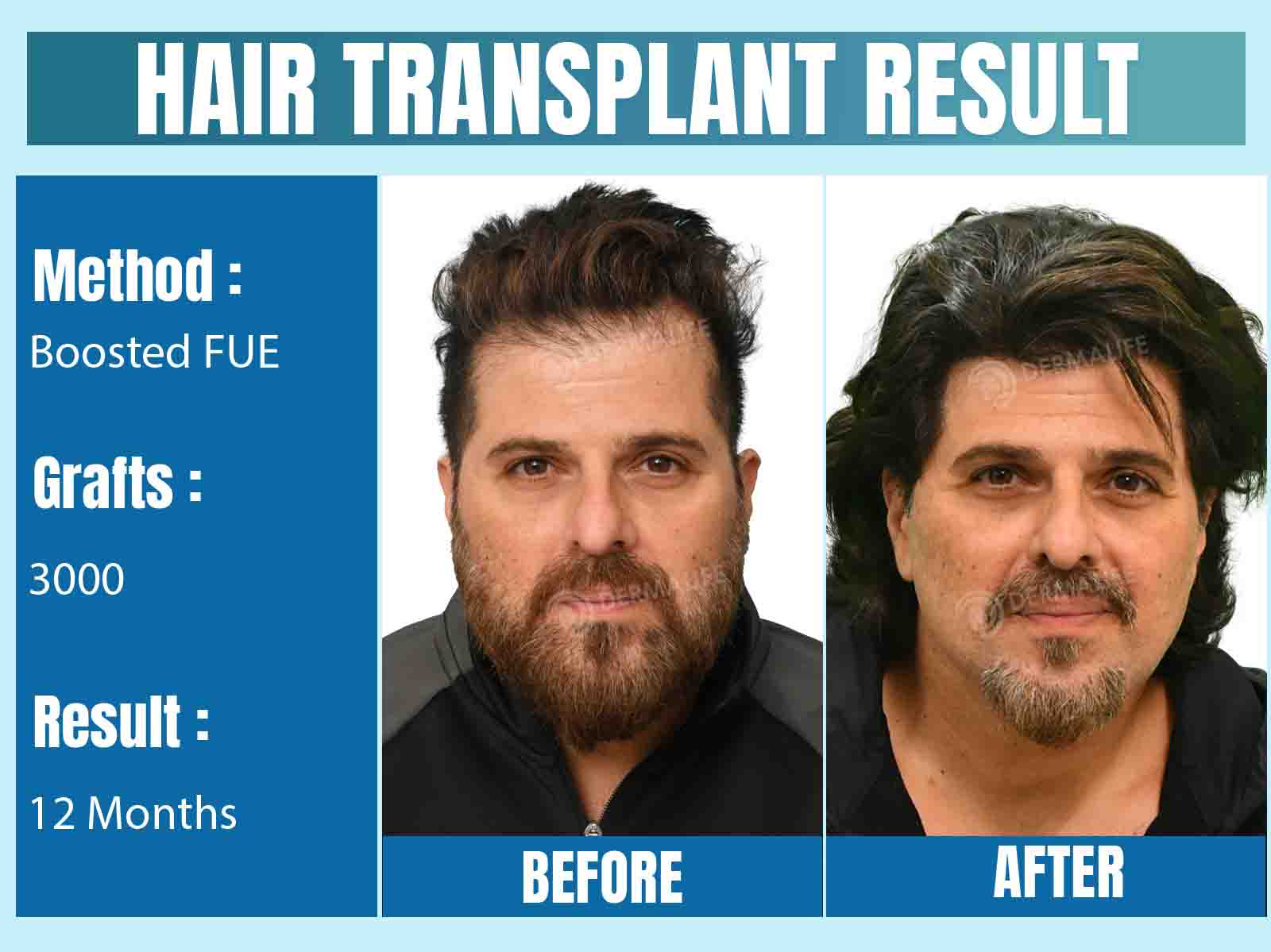 hair Transplant Before & After