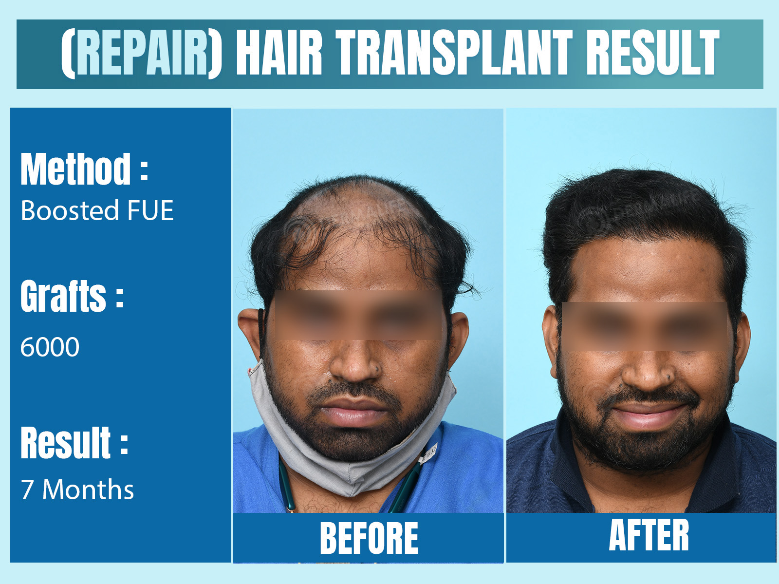 Before and After Results of Hair Transplant for Repair/ Corrective Hair Transplant