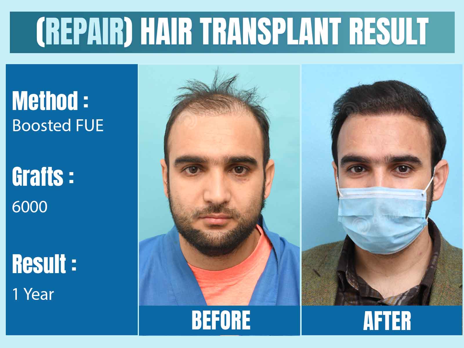 Before and After Results of Hair Transplant for Repair/ Corrective Hair Transplant