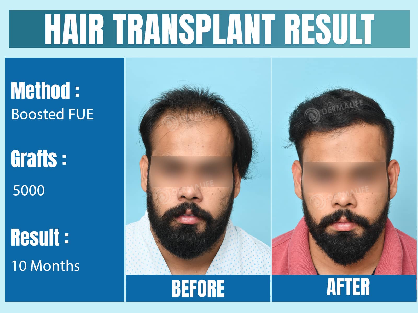 Before and After Results of Hair Transplant for Norwood Grade 5