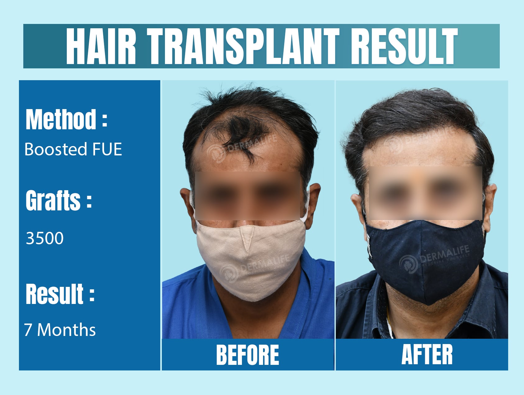 hair transplant best clinic in delhi