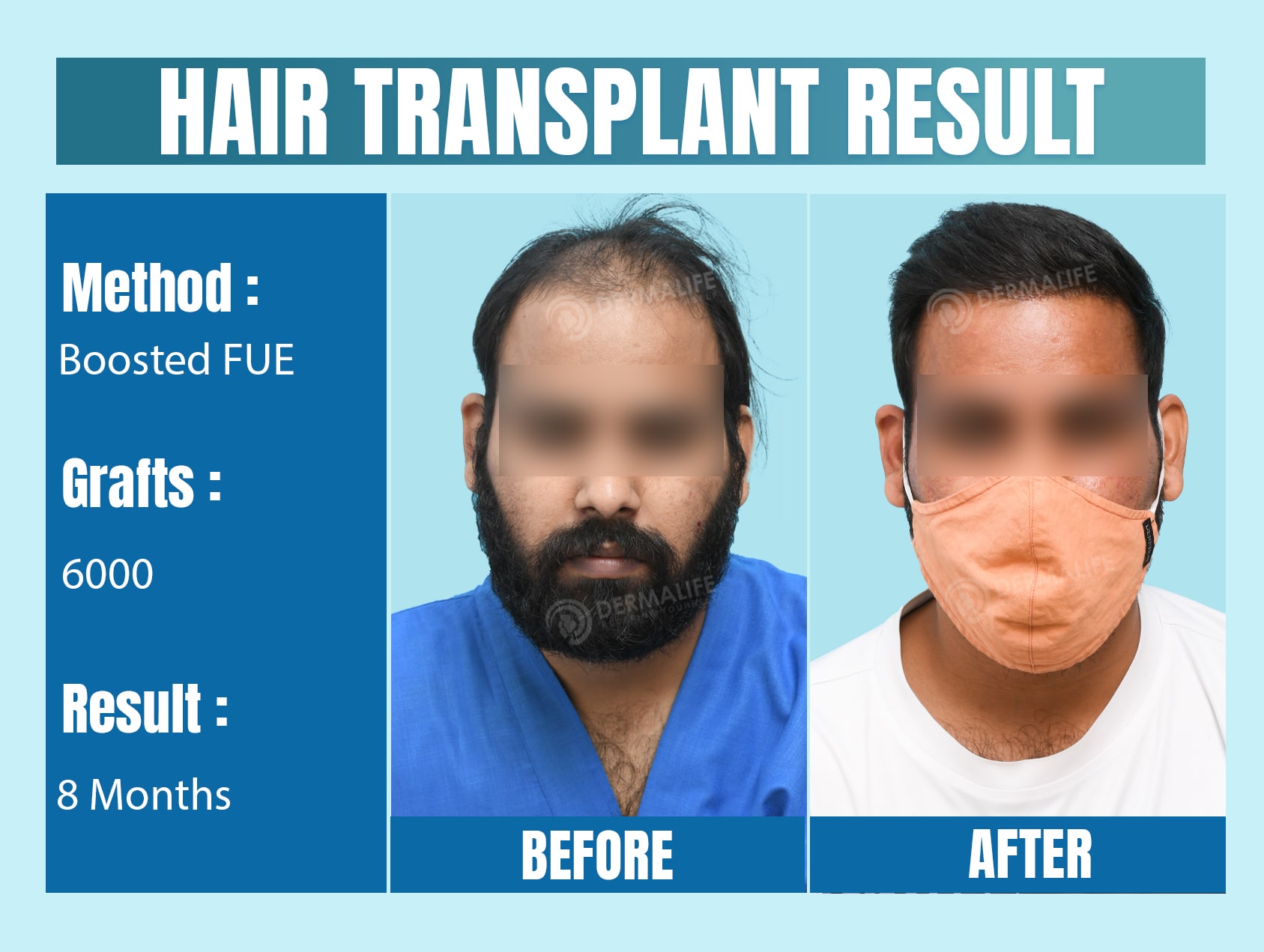 hair transplant centres in delhi