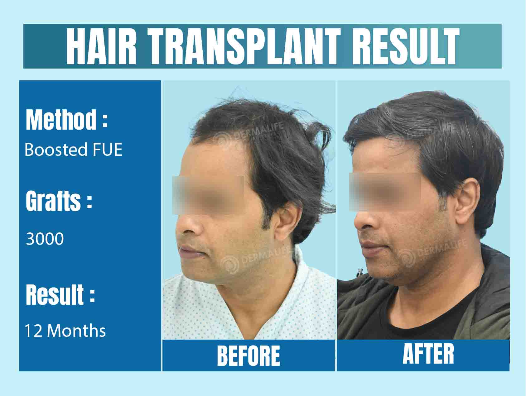 3000 grafts hair transplant cost in Delhi
