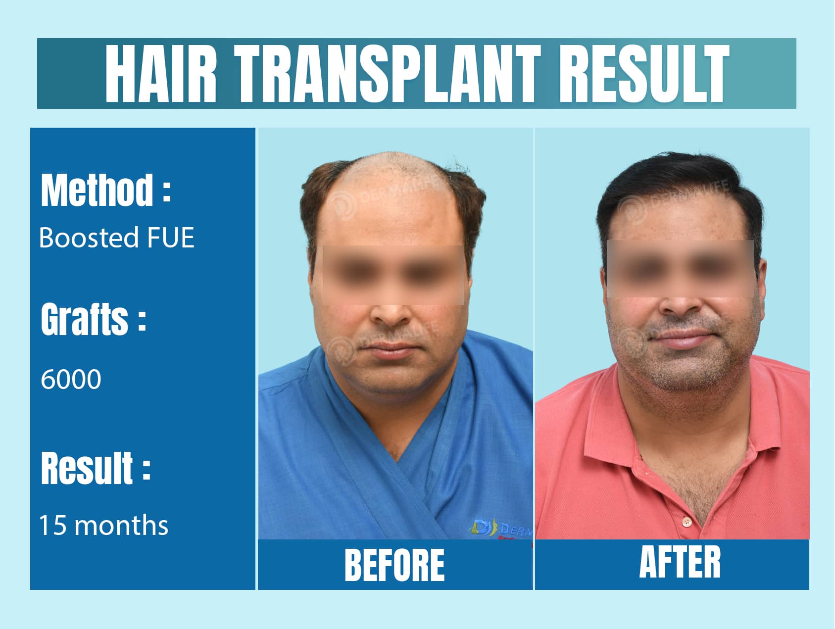 hair transplants clinic in Delhi