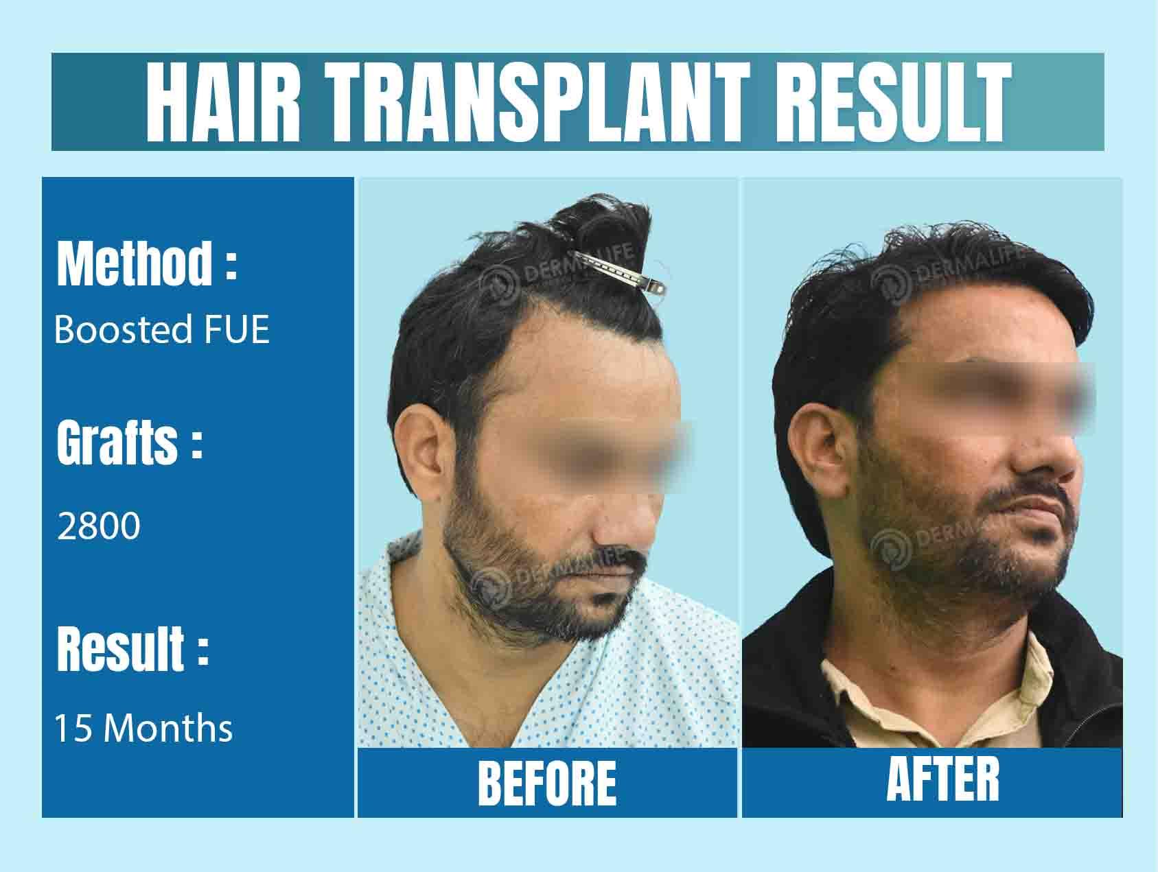 hair transplant clinic in delhi