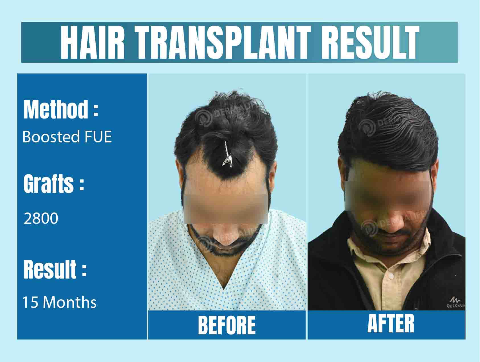 hair transplant clinic in delhi