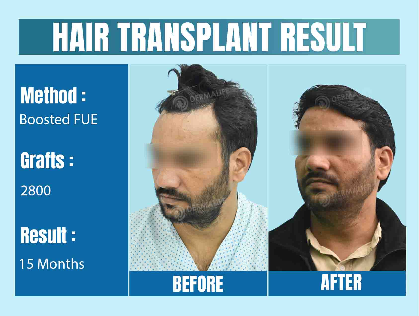 hair transplant clinic in delhi