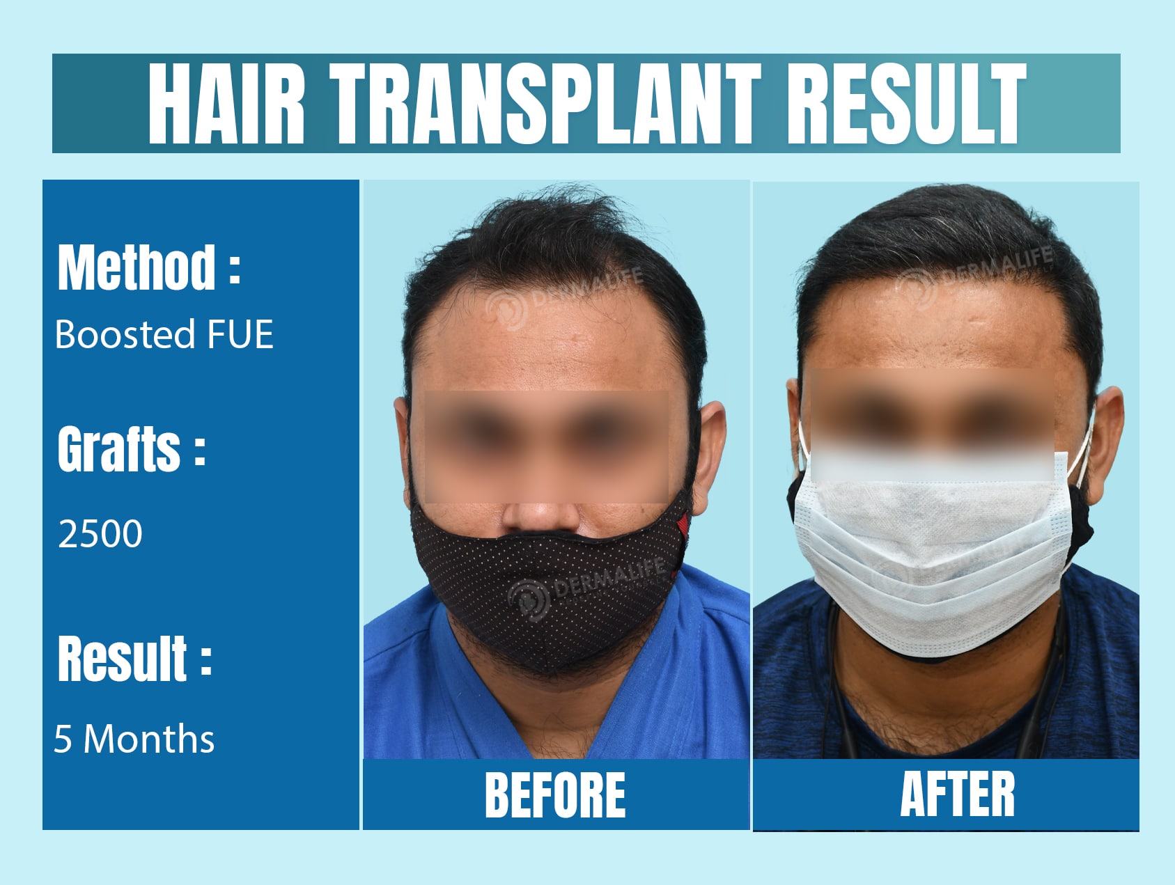 hair transplant clinics in Delhi