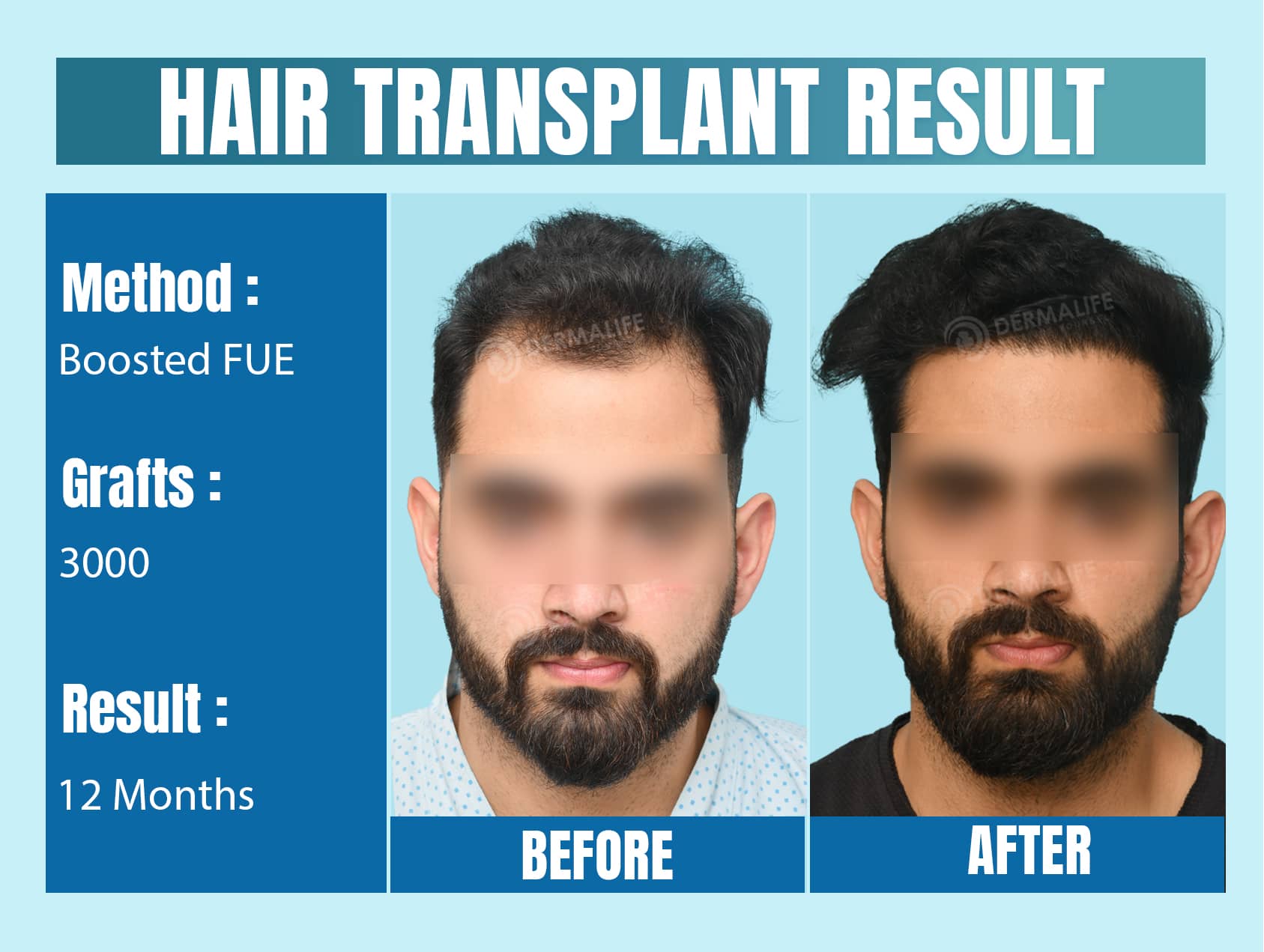 hair transplant cost in India