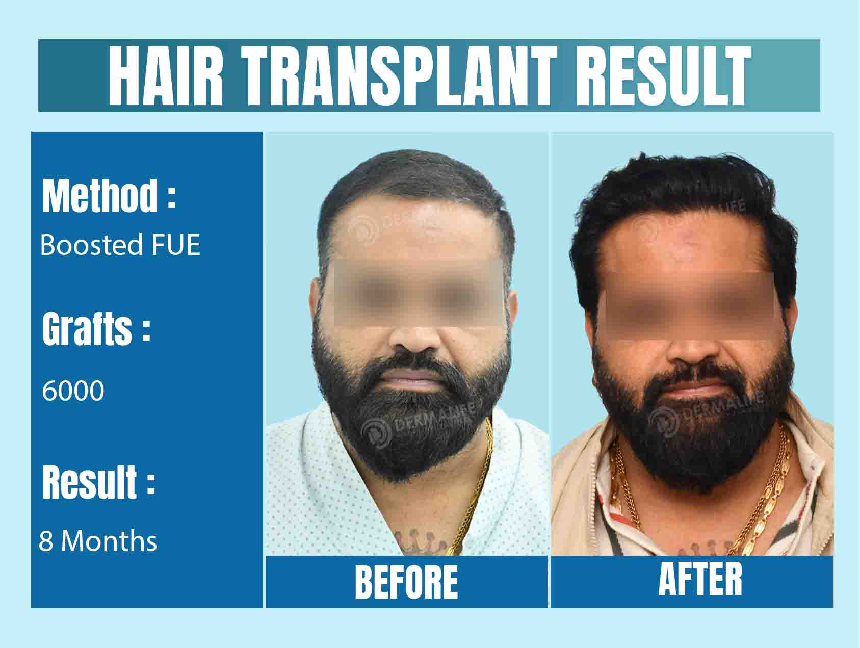 Top Hair Transplant Surgeon in Delhi