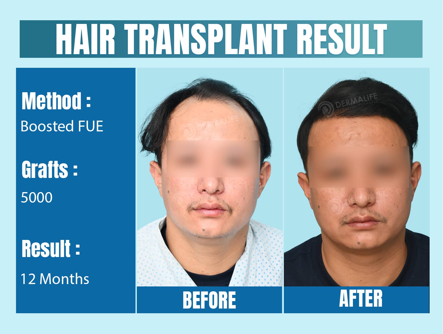 hair transplant doctor in delhi