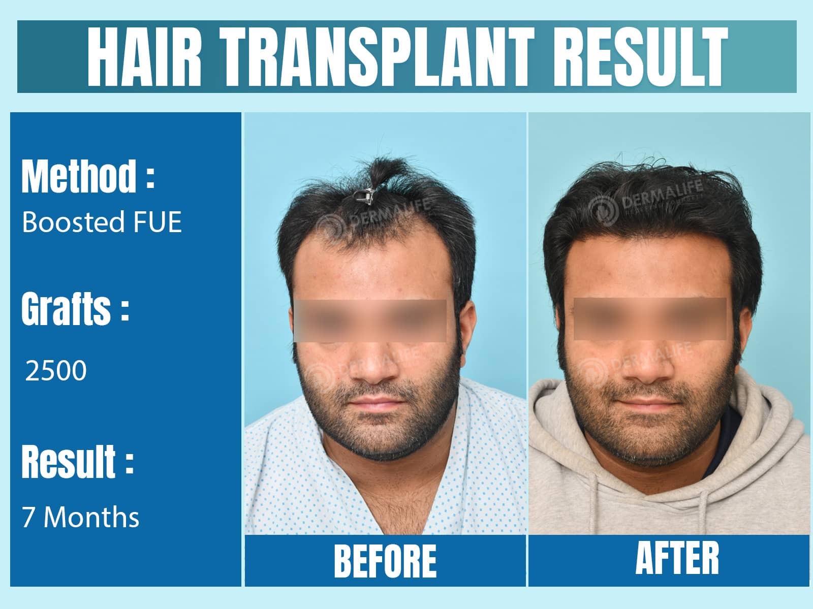 Before and After Results of Hair Transplant for Norwood Grade 2