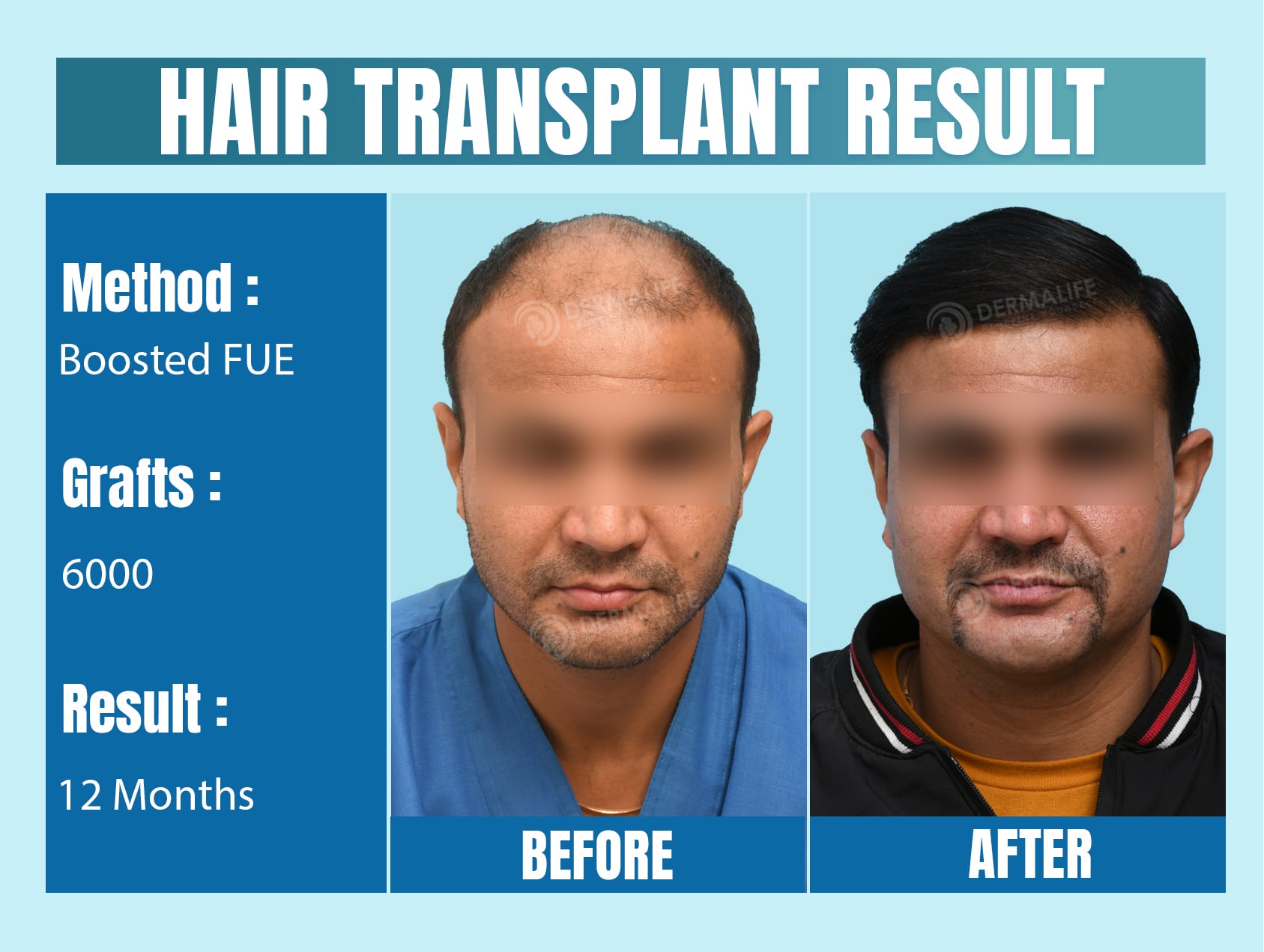 hair transplant new delhi