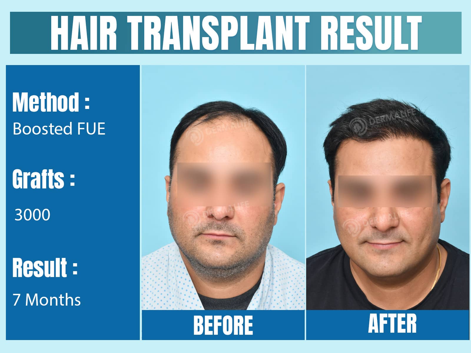 Before and After Results of Hair Transplant for Norwood Grade 3