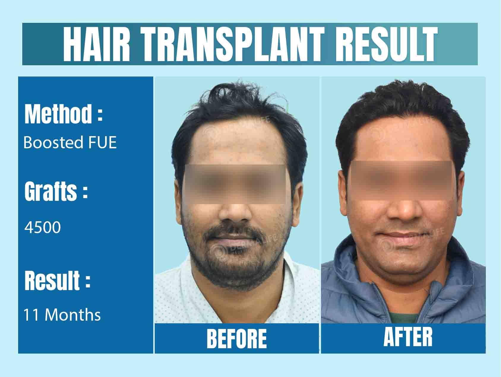 4500 grafts hair transplant cost in India