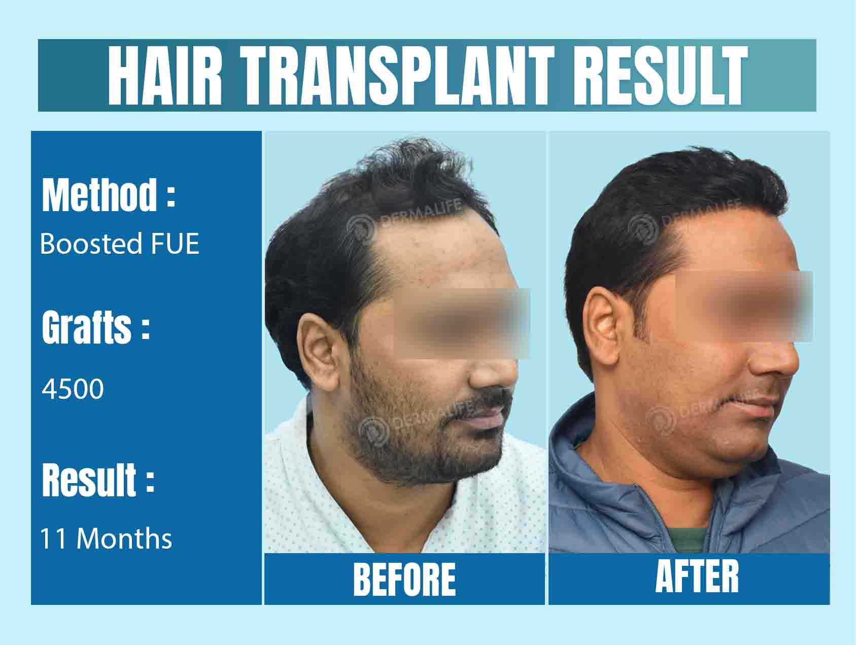 4500 grafts hair transplant cost in India