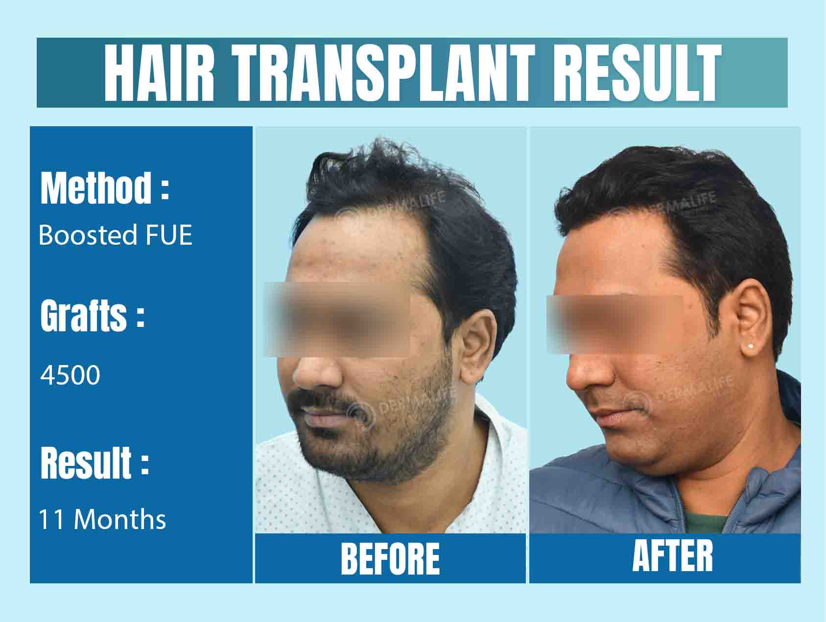 top hair transplant surgeon in Delhi