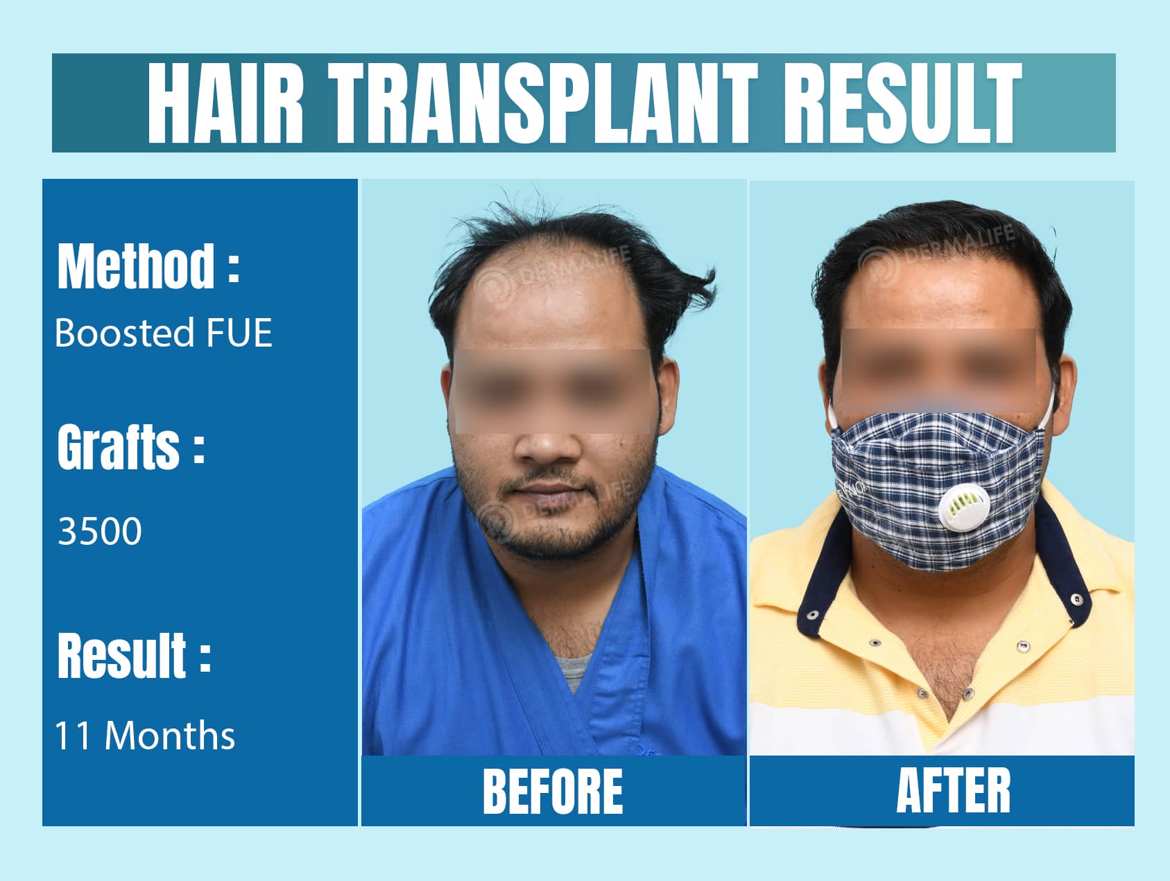 hair transplant surgeon in delhi